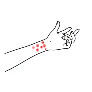 Detailed drawing of arm showing allergy skin prick test on forearm with small red welts, hand with all 5 fingers visible sticker