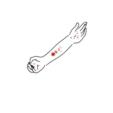 Detailed drawing of arm showing allergy skin prick test on forearm with small red welts, hand with all 5 fingers visible sticker