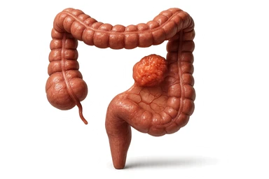colon umano anatomico realistico malato di cancro, fai un punto visibile in cui si nota proprio la massa tumorale,+ iperrealistico 4k sticker