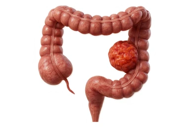 colon umano anatomico realistico malato di cancro, fai un punto visibile in cui si nota proprio la massa tumorale, iperrealistico 4k sticker