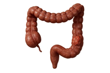 colon umano anatomico realistico malato di cancro, fai un punto visibile in cui si nota proprio la massa tumorale, iperrealistico 4k sticker