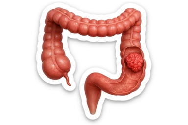 colon umano anatomico realistico malato di cancro, fai un punto visibile in cui si nota proprio la massa tumorale,+ iperrealistico 4k sticker