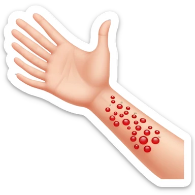 Allergy skin prick test on forearm with small red bumps showing reactions to different allergens, with 5 fingers of the hand visible sticker