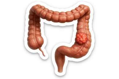 colon umano anatomico realistico malato di cancro, fai un punto visibile in cui si nota proprio la massa tumorale,+ iperrealistico 4k sticker