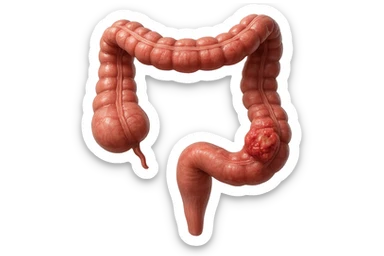 colon umano anatomico realistico malato di cancro, fai un punto visibile in cui si nota proprio la massa tumorale,+ iperrealistico 4k sticker