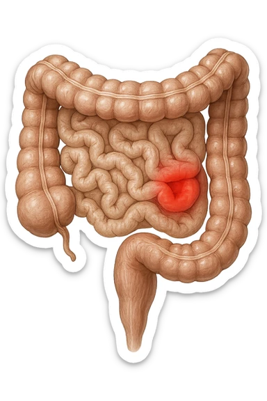 intestino anatomico realistico con red spot di infiammazione sticker