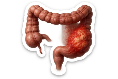 colon umano anatomico realistico malato di cancro, fai un punto visibile in cui si nota proprio la massa tumorale,+ iperrealistico 4k sticker