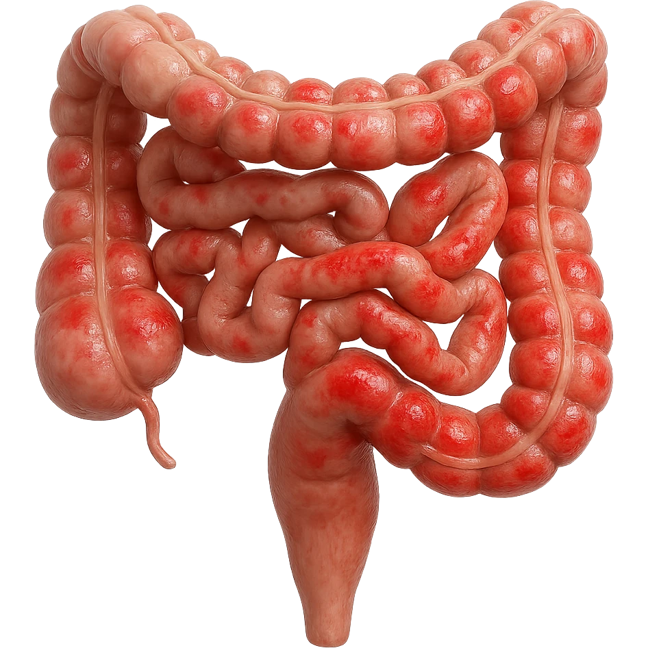 intestino umano anatomico con rossori sparsi sul colonm, iperrealistico 4k emoji