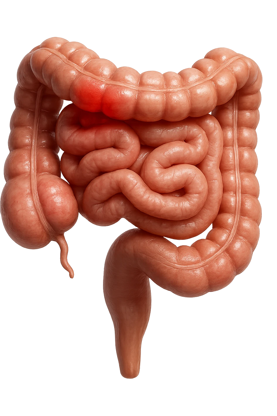 intestino anatomico realistico con red spot di infiammazione, IPERREALISTICO 4K emoji