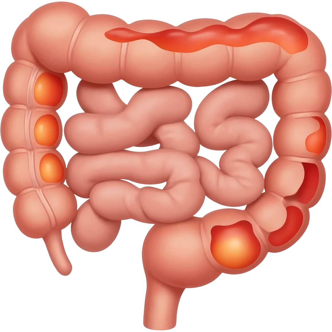 endoscopy for crohn's disease emoji